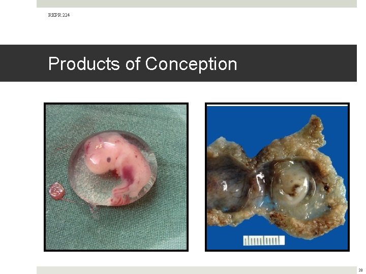 REPR 224 Products of Conception 20 