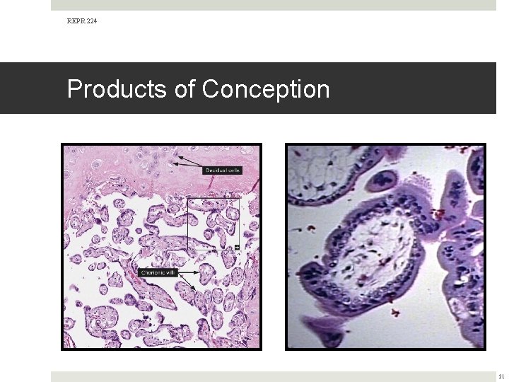 REPR 224 Products of Conception 21 