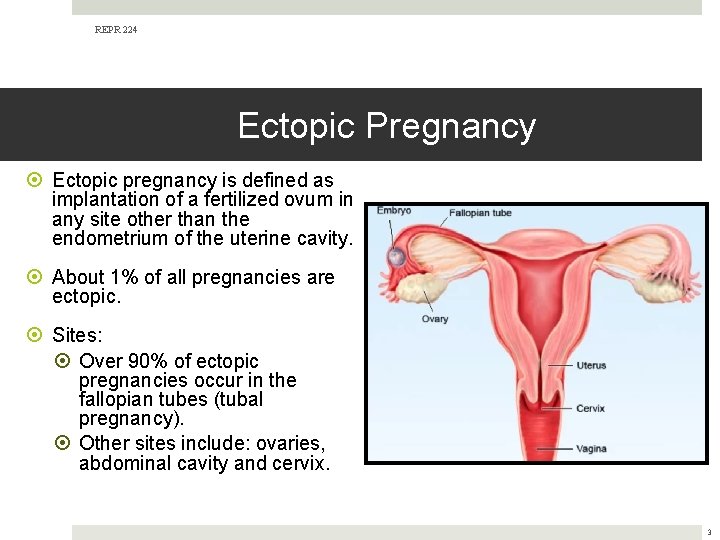 REPR 224 Ectopic Pregnancy Ectopic pregnancy is defined as implantation of a fertilized ovum