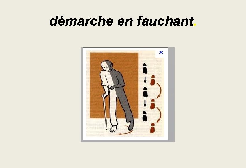 démarche en fauchant. démarche en fauchant.
