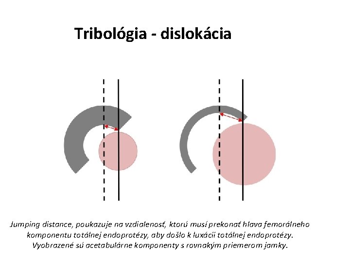 Tribológia - dislokácia Jumping distance, poukazuje na vzdialenosť, ktorú musí prekonať hlava femorálneho komponentu