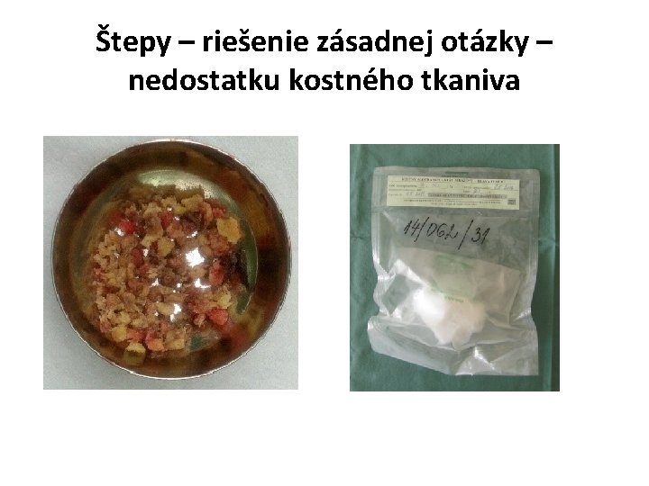 Štepy – riešenie zásadnej otázky – nedostatku kostného tkaniva 