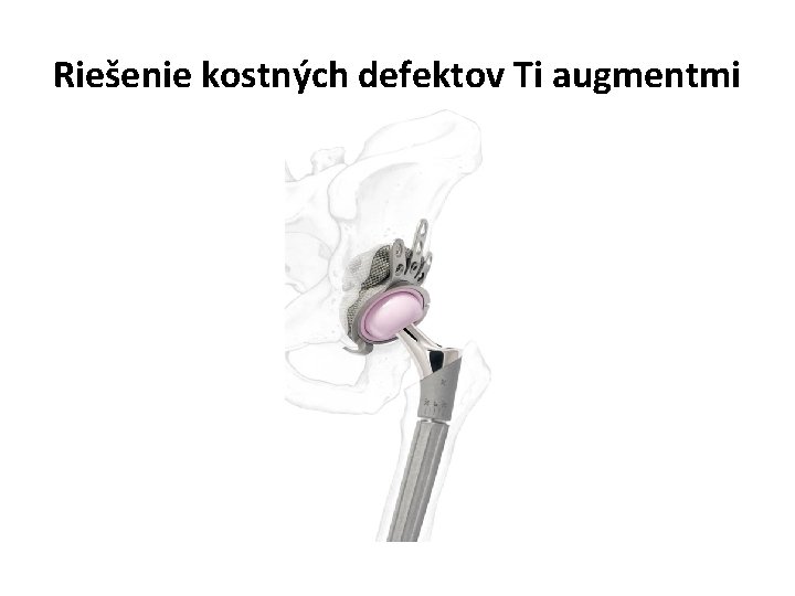 Riešenie kostných defektov Ti augmentmi 