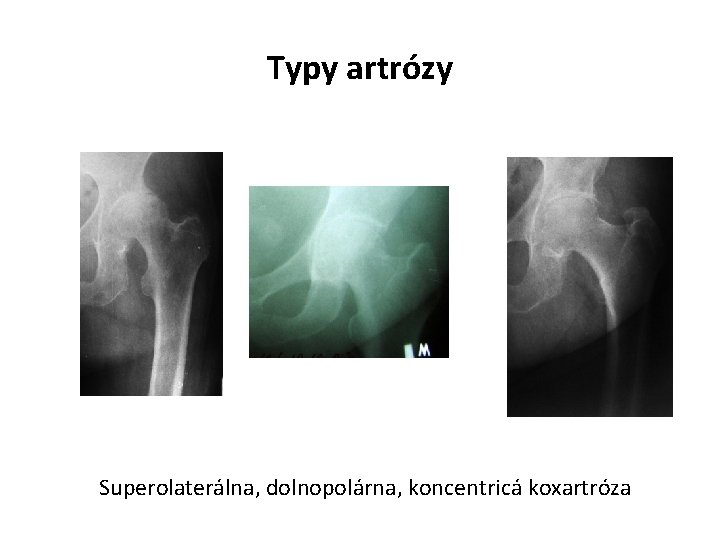 Typy artrózy Superolaterálna, dolnopolárna, koncentricá koxartróza 