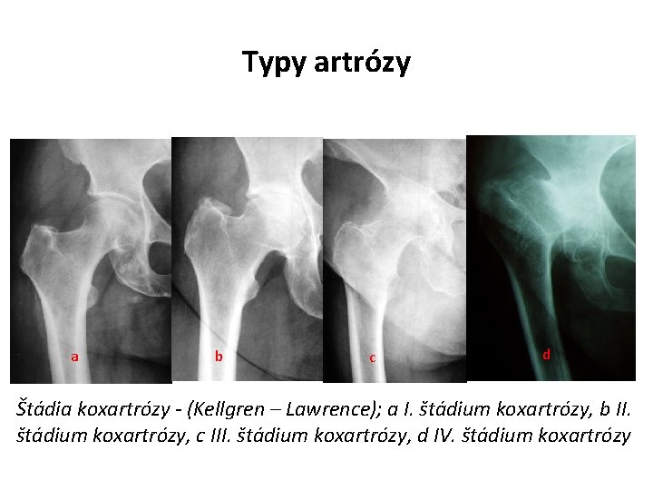 Typy artrózy a b c d Štádia koxartrózy - (Kellgren – Lawrence); a I.