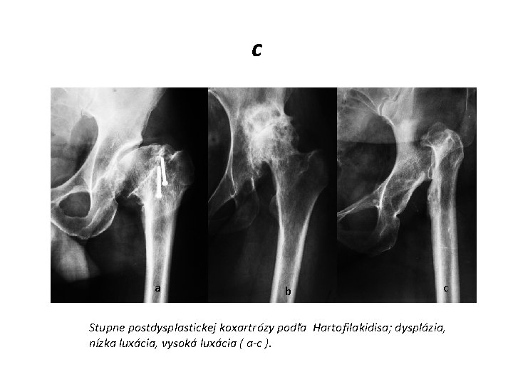 c a b c Stupne postdysplastickej koxartrózy podľa Hartofilakidisa; dysplázia, nízka luxácia, vysoká luxácia