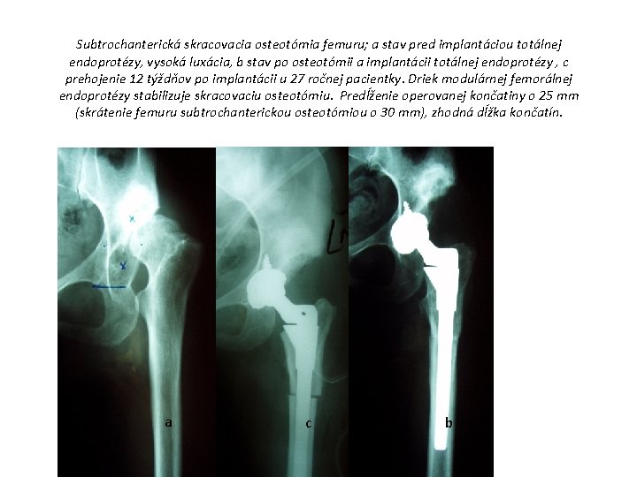 Subtrochanterická skracovacia osteotómia femuru; a stav pred implantáciou totálnej endoprotézy, vysoká luxácia, b stav