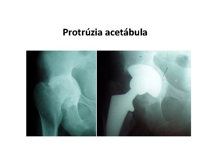 Protrúzia acetábula 