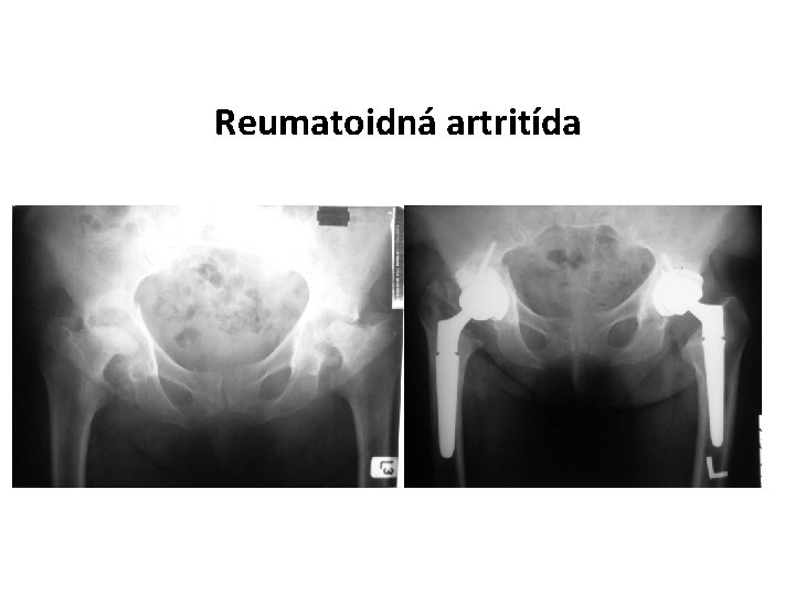 Reumatoidná artritída 