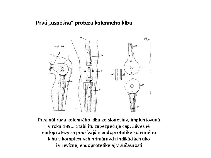 Prvá „úspešná“ protéza kolenného kĺbu Prvá náhrada kolenného kĺbu zo slonoviny, implantovaná v roku