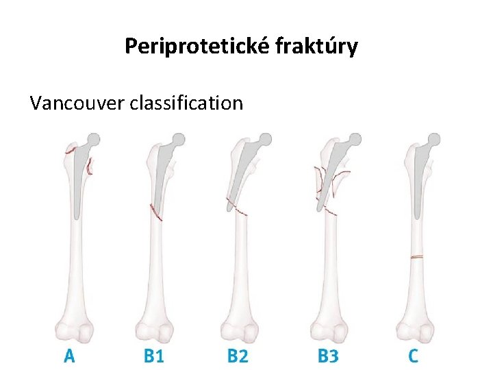 Periprotetické fraktúry Vancouver classification 