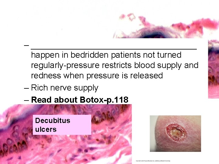 – __________________ happen in bedridden patients not turned regularly-pressure restricts blood supply and redness