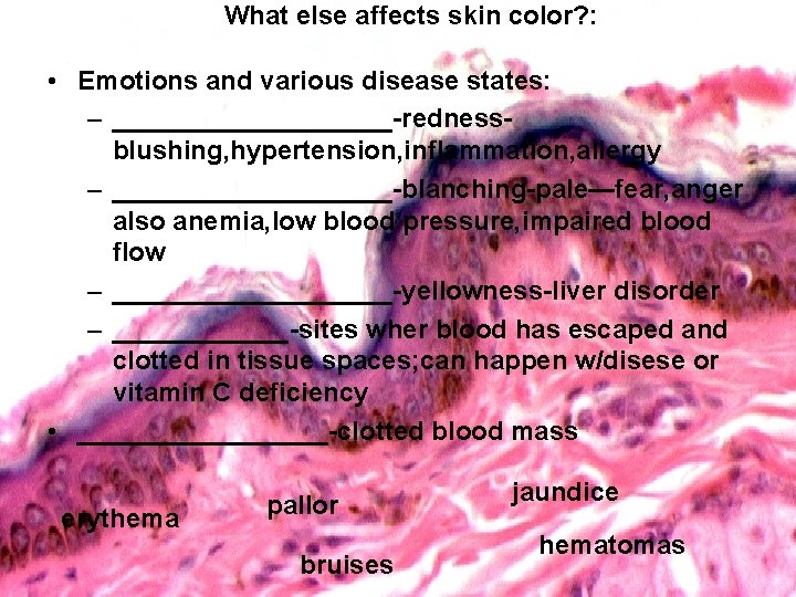 What else affects skin color? : • Emotions and various disease states: – __________-rednessblushing,