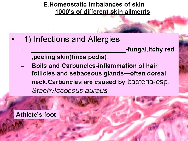 E. Homeostatic imbalances of skin 1000’s of different skin ailments • 1) Infections and