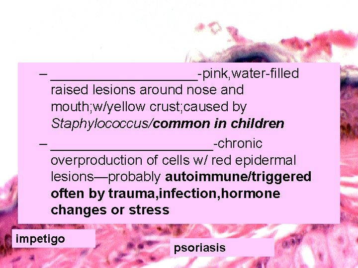 – __________-pink, water-filled raised lesions around nose and mouth; w/yellow crust; caused by Staphylococcus/common