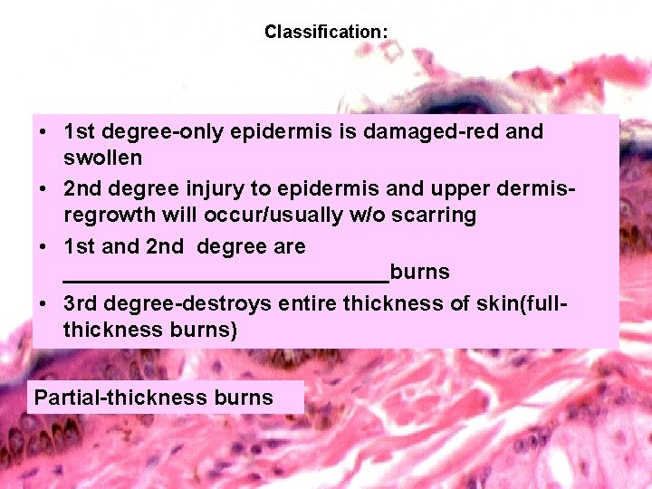 Classification: • 1 st degree-only epidermis is damaged-red and swollen • 2 nd degree