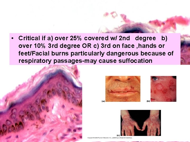  • Critical if a) over 25% covered w/ 2 nd degree b) over