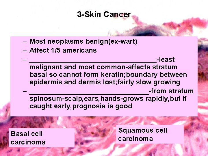 3 -Skin Cancer – Most neoplasms benign(ex-wart) – Affect 1/5 americans – _________________-least malignant