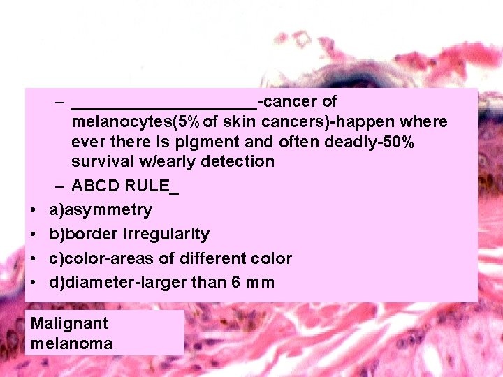  • • – __________-cancer of melanocytes(5%of skin cancers)-happen where ever there is pigment