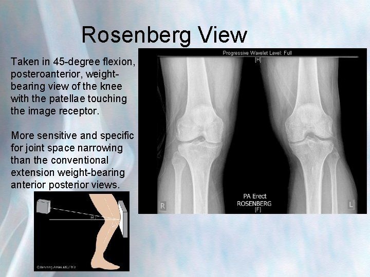 Rosenberg View Taken in 45 -degree flexion, posteroanterior, weightbearing view of the knee with