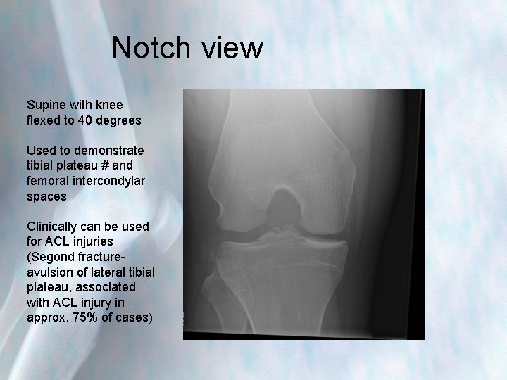 Notch view Supine with knee flexed to 40 degrees Used to demonstrate tibial plateau