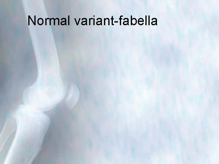 Normal variant-fabella 