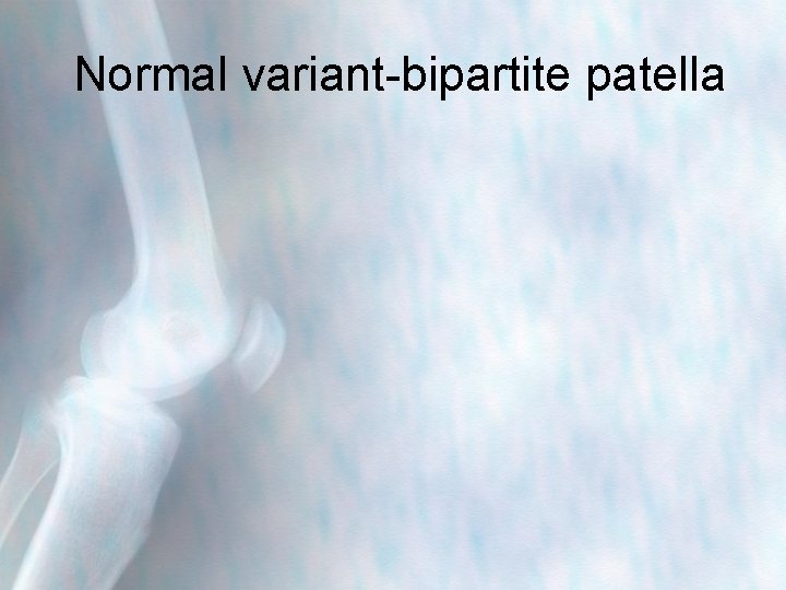 Normal variant-bipartite patella 