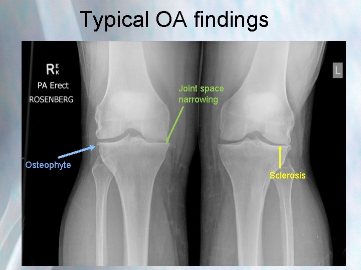 Typical OA findings Joint space narrowing Osteophyte Sclerosis 