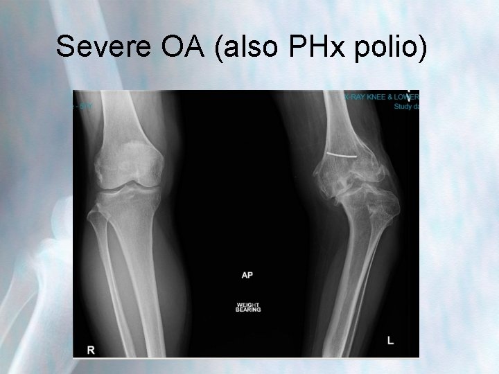 Severe OA (also PHx polio) 