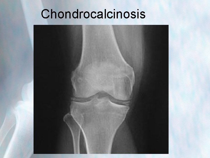 Chondrocalcinosis 