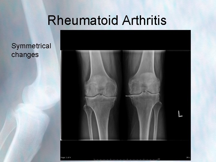 Rheumatoid Arthritis Symmetrical changes 