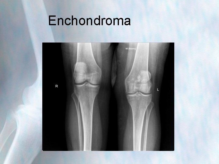 Enchondroma 