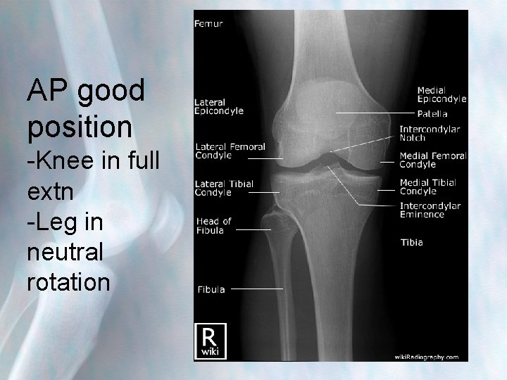 AP good position -Knee in full extn -Leg in neutral rotation 