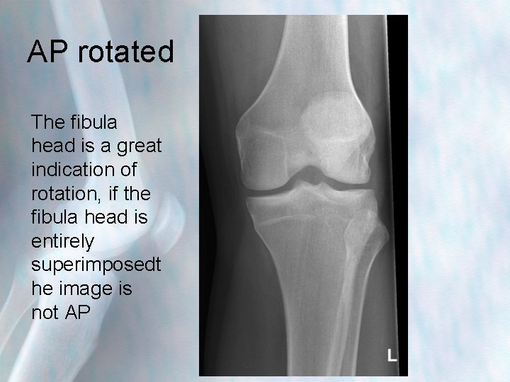 AP rotated The fibula head is a great indication of rotation, if the fibula