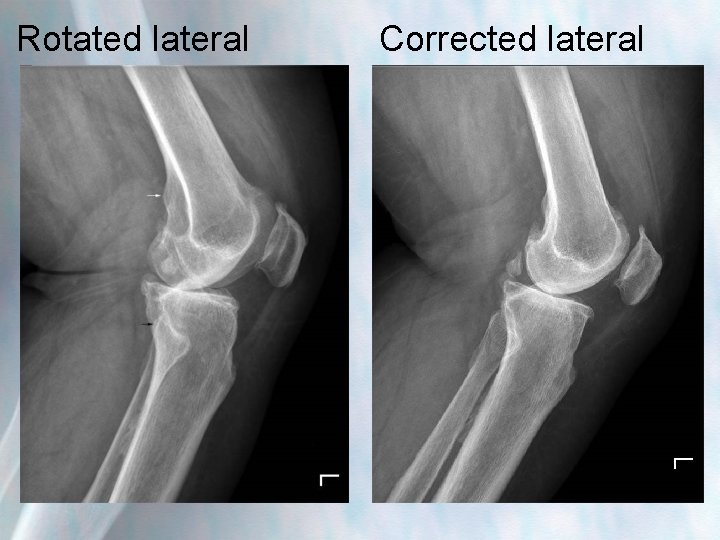 Rotated lateral Corrected lateral 