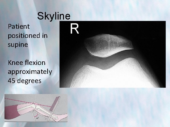 Skyline Patient positioned in supine Knee flexion approximately 45 degrees 