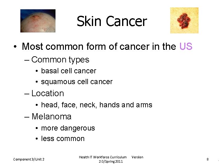 Skin Cancer • Most common form of cancer in the US – Common types