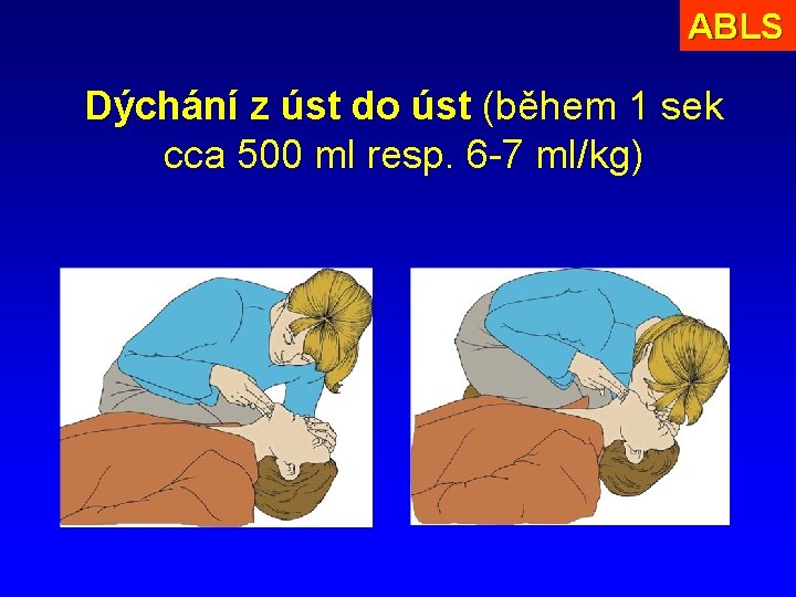 ABLS Dýchání z úst do úst (během 1 sek cca 500 ml resp. 6