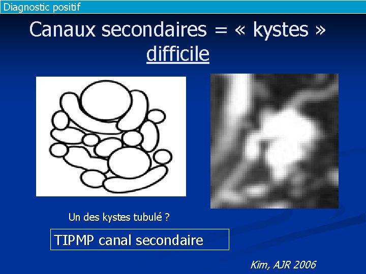 Diagnostic positif Canaux secondaires = « kystes » difficile Un des kystes tubulé ?