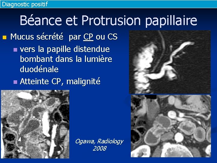 Diagnostic positif Béance et Protrusion papillaire n Mucus sécrété par CP ou CS n