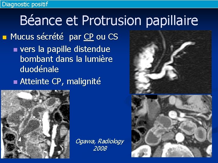 Diagnostic positif Béance et Protrusion papillaire n Mucus sécrété par CP ou CS n Diagnostic positif Béance et Protrusion papillaire n Mucus sécrété par CP ou CS n