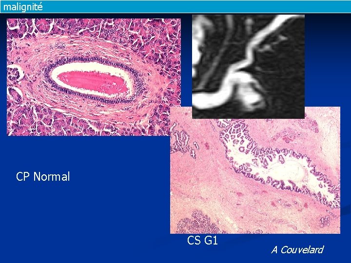 malignité CP Normal CS G 1 A Couvelard 