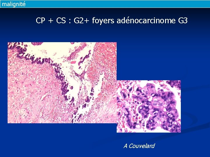 malignité CP + CS : G 2+ foyers adénocarcinome G 3 A Couvelard malignité CP + CS : G 2+ foyers adénocarcinome G 3 A Couvelard
