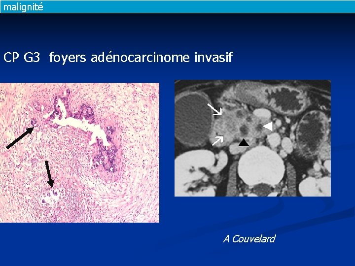 malignité CP G 3 foyers adénocarcinome invasif A Couvelard malignité CP G 3 foyers adénocarcinome invasif A Couvelard