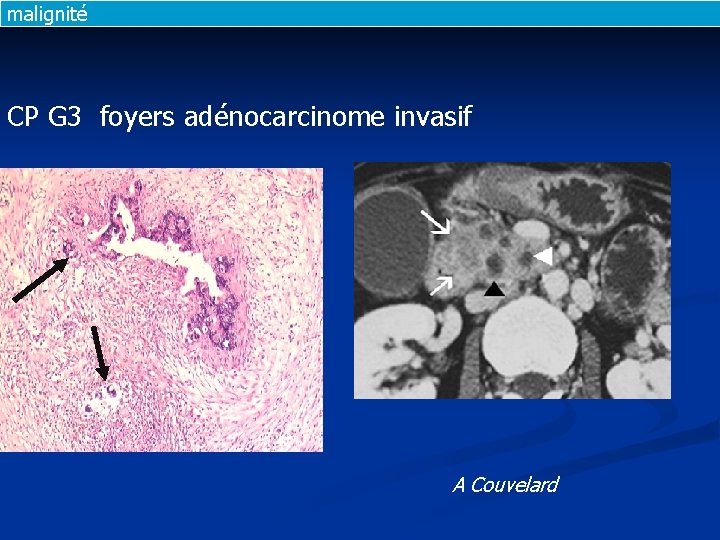 malignité CP G 3 foyers adénocarcinome invasif A Couvelard 