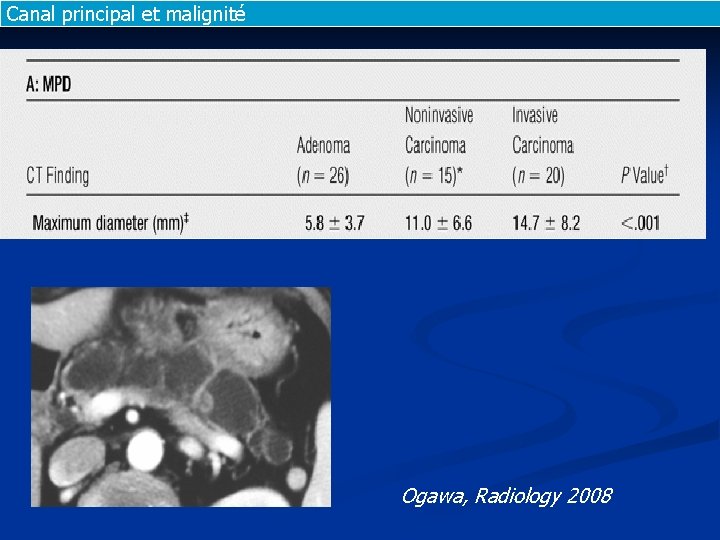 Canal principal et malignité Ogawa, Radiology 2008 Canal principal et malignité Ogawa, Radiology 2008