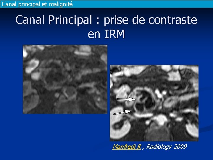 Canal principal et malignité Canal Principal : prise de contraste en IRM Manfredi R