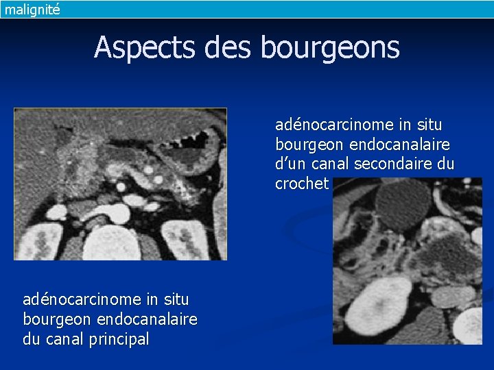 malignité Aspects des bourgeons adénocarcinome in situ bourgeon endocanalaire d’un canal secondaire du crochet