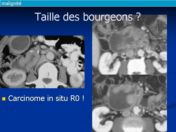 malignité Taille des bourgeons ? n Carcinome in situ R 0 ! 