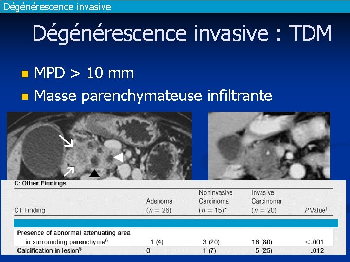 Dégénérescence invasive : TDM n n MPD > 10 mm Masse parenchymateuse infiltrante Vullierme, Dégénérescence invasive : TDM n n MPD > 10 mm Masse parenchymateuse infiltrante Vullierme,